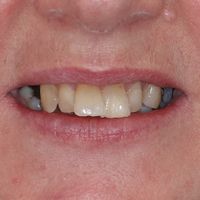 Dental Bridge - Smile 9 before